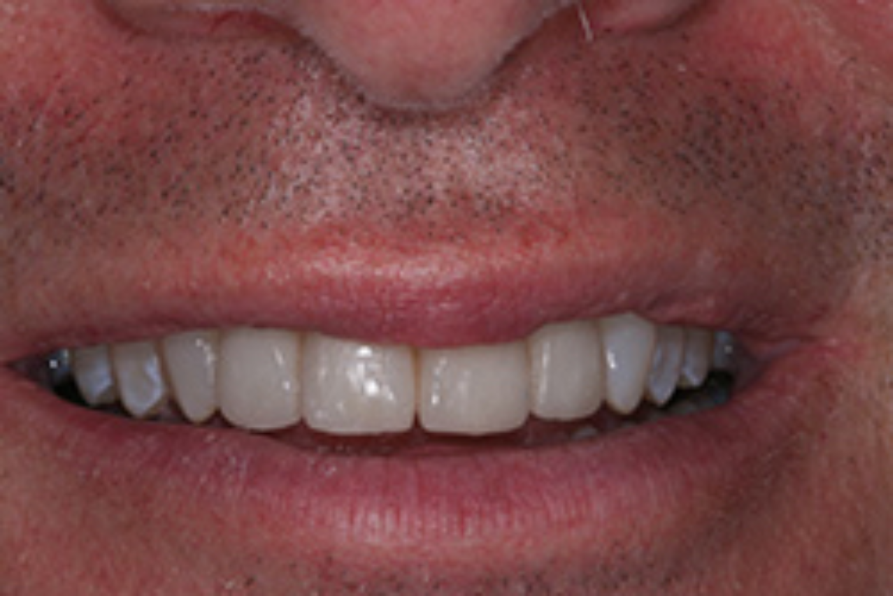 Success Stories 15 4 Veneers After Gum Treatment 2