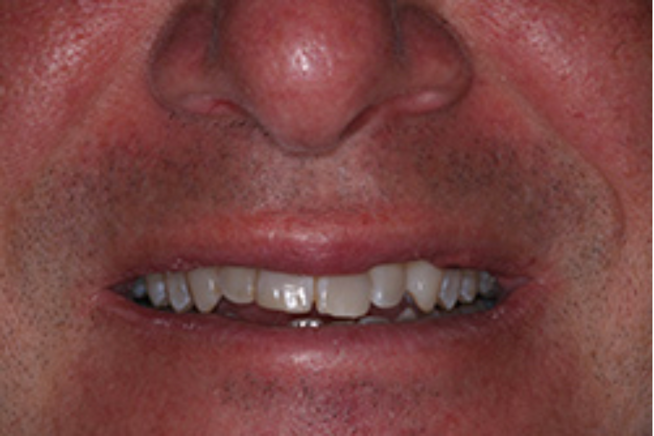 Success Stories 14 4 Veneers After Gum Treatment