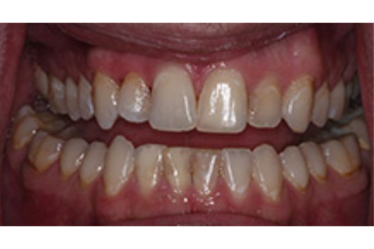 Success Stories 11 6 Veneers and a New Smile