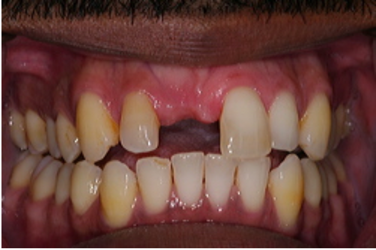 Success Stories 9 Dental Implant Helps Restore a Smile 3