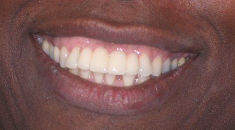 Success Stories 17 Missing Teeth Restored With Implants 2 e1715100417532