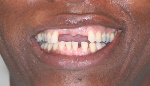 Success Stories 16 Missing Teeth Restored With Implants e1715100362159