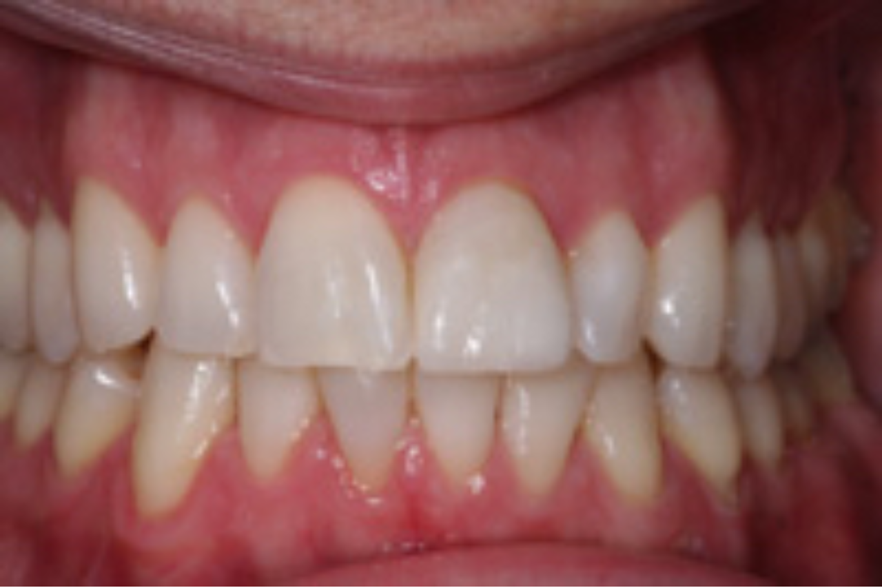 Success Stories 21 Porcelain Veneer Used to Replace Old Bonding 2