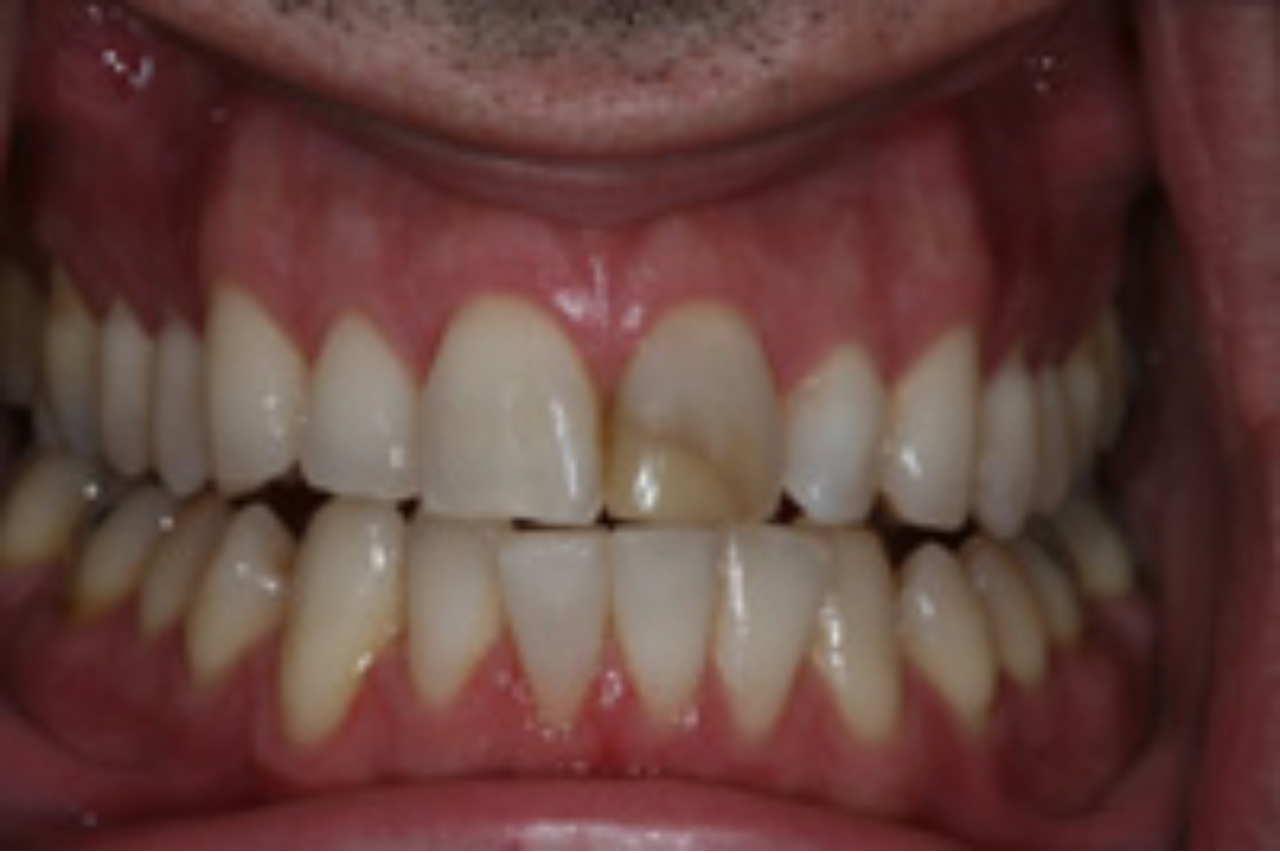 Success Stories 20 Porcelain Veneer Used to Replace Old Bonding