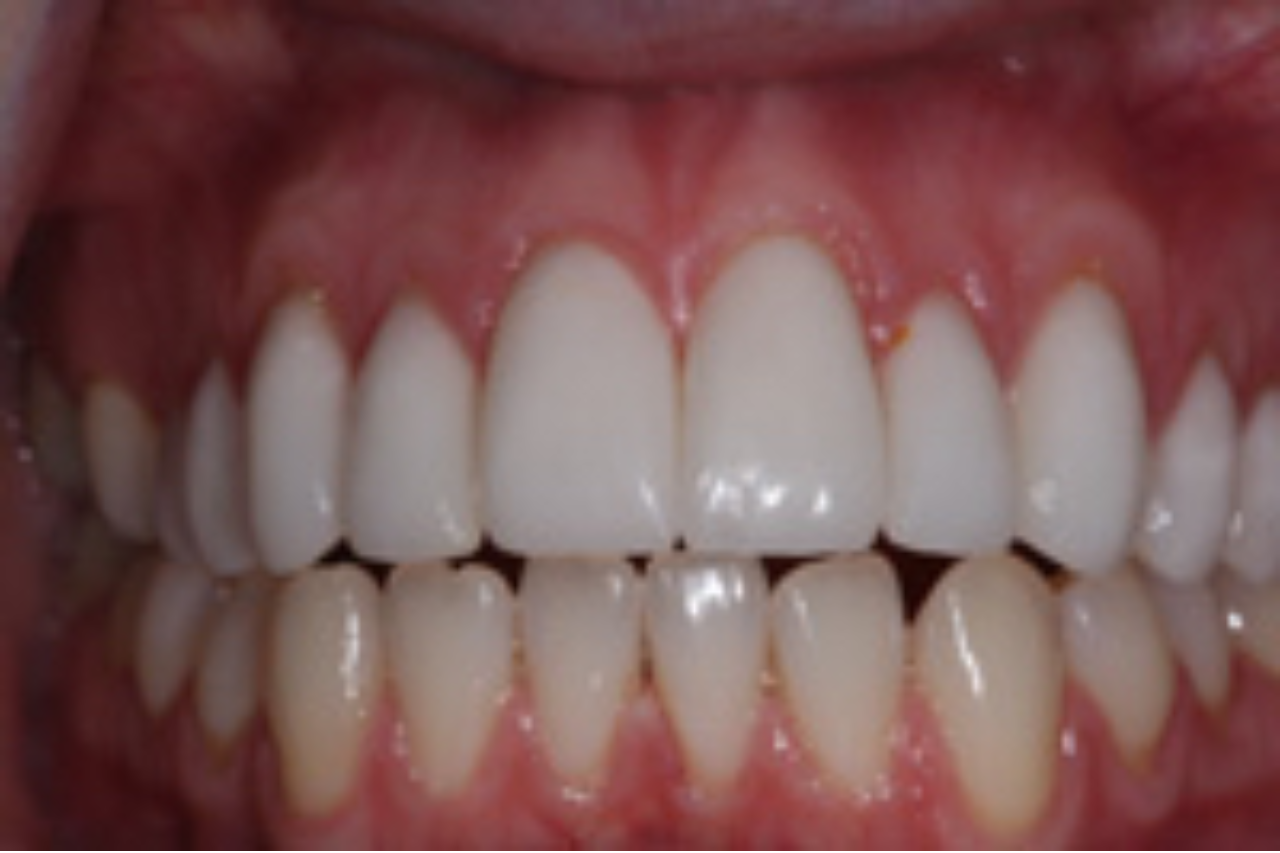 Success Stories 19 Tooth Size Corrected With Gum Treatment and 10 Veneers 1