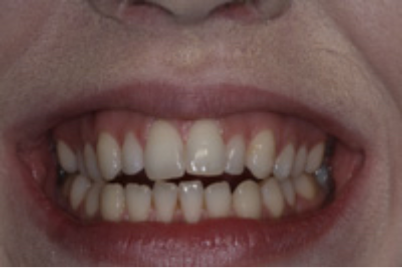 Success Stories 18 Tooth Size Corrected With Gum Treatment and 10 Veneers 2