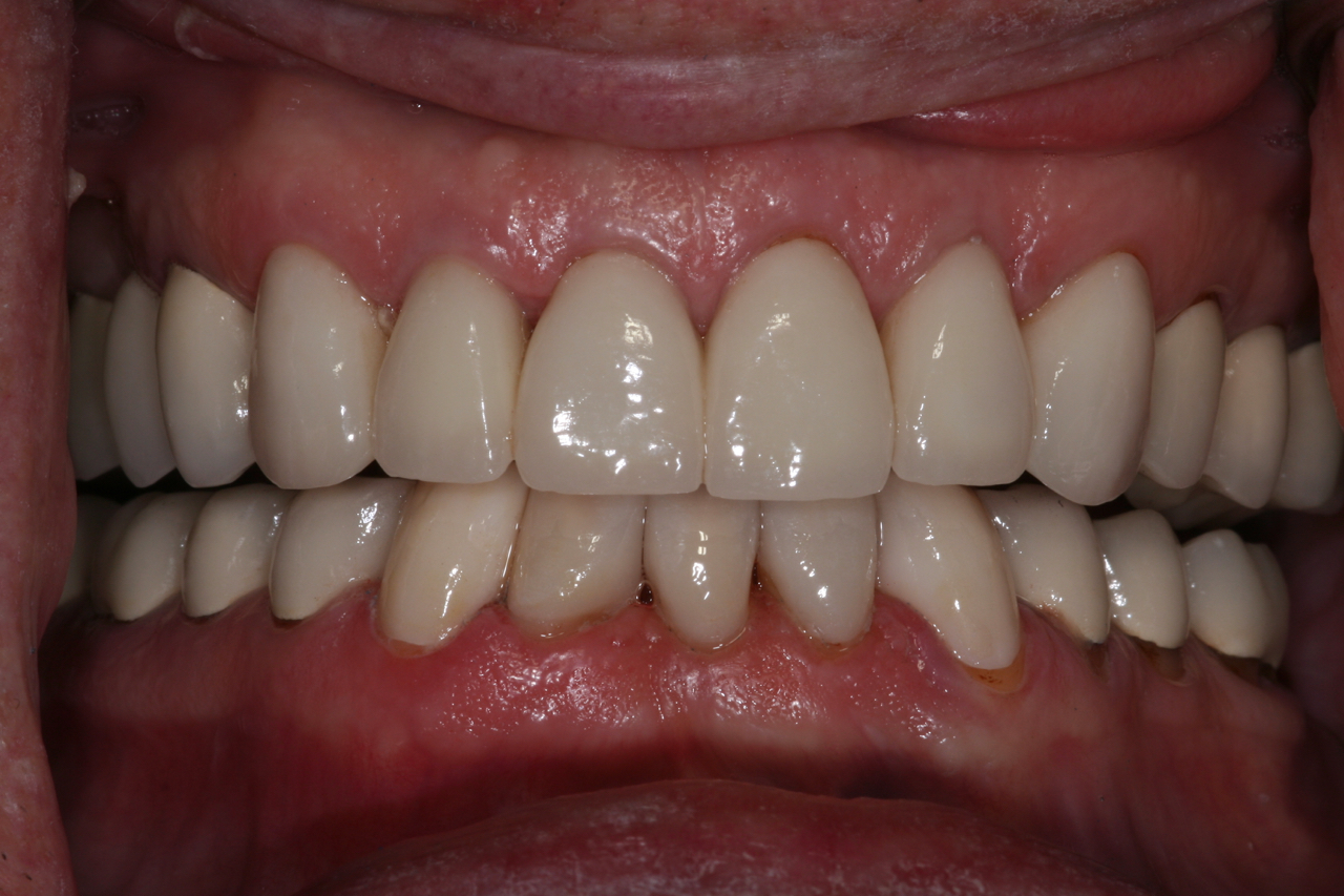 Success Stories 23 Total Smile Restoration With Crowns and Porcelain Veneers 2 1
