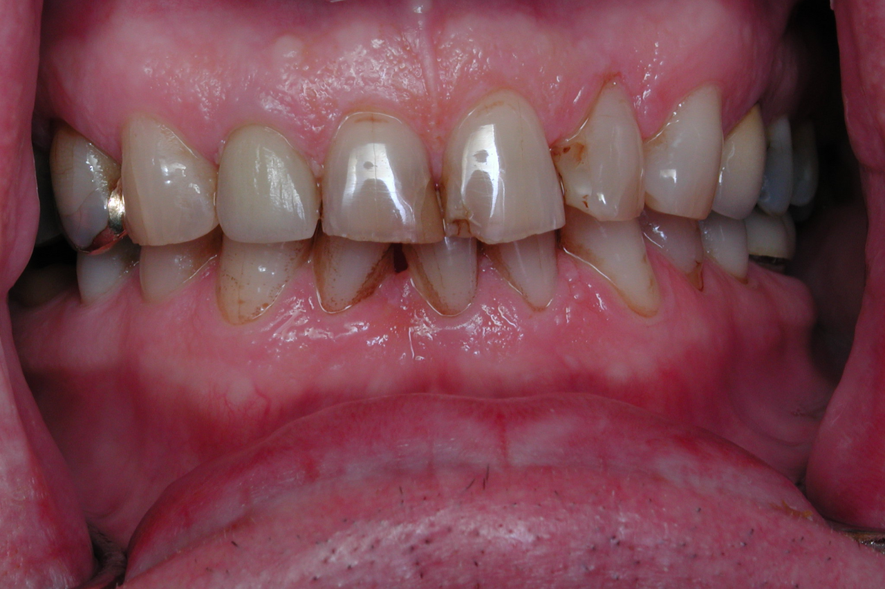 Success Stories 22 Total Smile Restoration With Crowns and Porcelain Veneers