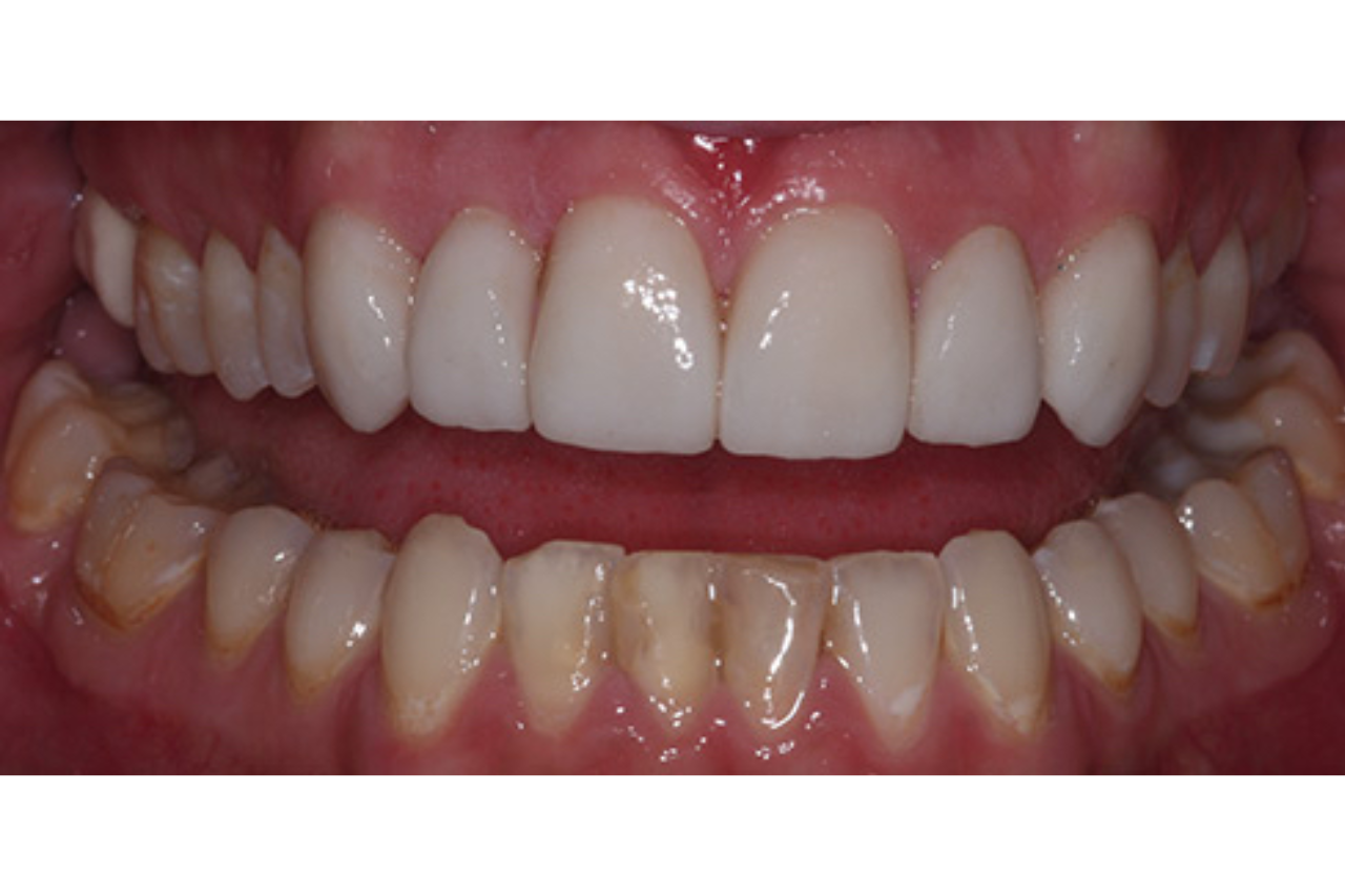 Success Stories 12 Veneer Used to Fix Broken Front Tooth 1