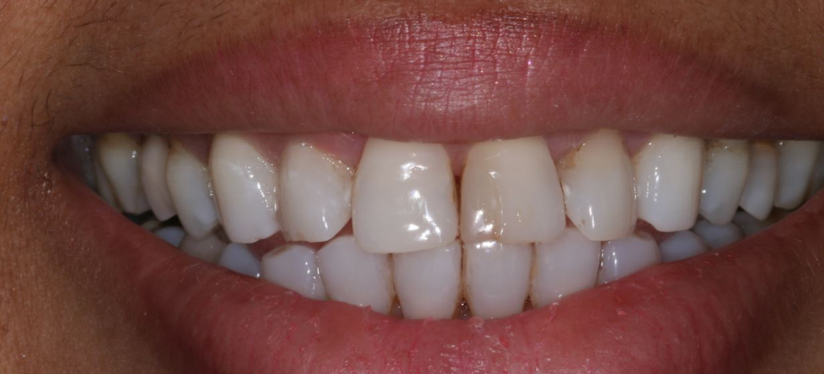 Success Stories 1 Veneers Before