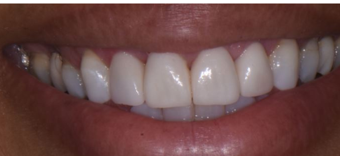 Success Stories 2 Veneers After